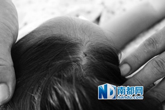 女童頭上被扎的針孔（圓圈處）。賈先生說，被扎不到三秒鐘，女兒就昏了。