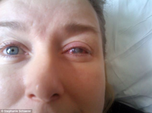 恐怖慎入！隱形眼鏡致英女子摘除眼球