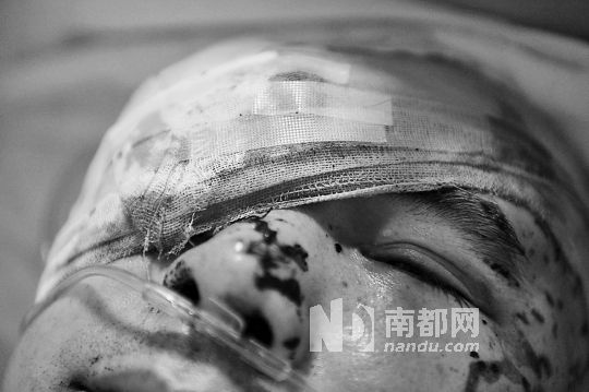李建新頭部還有被潑硫酸的痕跡，醫(yī)生說被砍傷的右眼已經失明。 南都記者 田飛 攝
