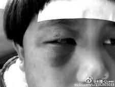 6月2日，網曝渭南市臨渭區(qū)一不滿5歲的女童遭奶奶毆打，眼圈青腫，引起網友關注，但孩子父母和爺爺均稱是摔倒導致。相關部門介入調查發(fā)現確為奶奶毆打所致，鑒于其身體原因已進行批評教育。
