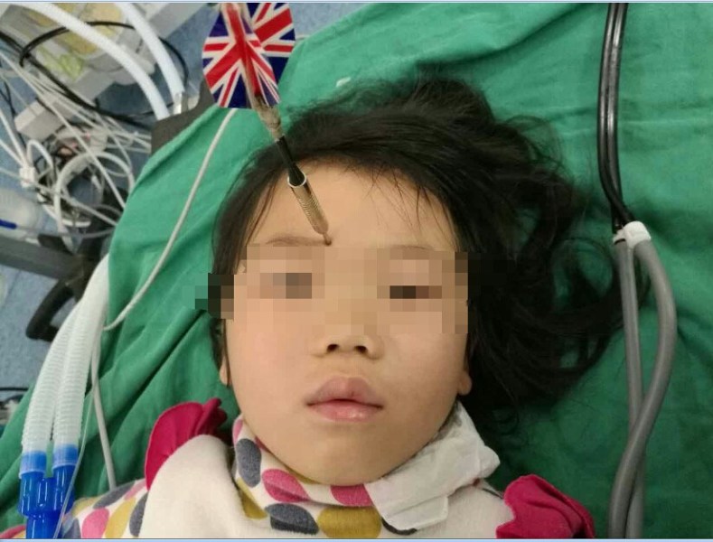 十多公分長的飛鏢穩(wěn)穩(wěn)地 ” 定 ” 在了一名六歲半的女童額頭上，小青一家人凌晨從長順趕到貴醫(yī)附院急診室時(shí)，看到如此慘烈的情況，接診醫(yī)生都嚇了一跳。詳細(xì)詢問下得知，原來是七歲的哥哥和六歲半的表妹在玩耍時(shí)，哥哥不慎將路邊撿來的真飛鏢扎到了妹妹的額頭上。