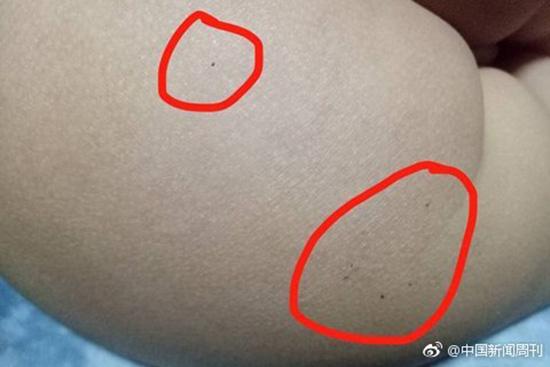 據(jù)多名紅黃藍(lán)(新天地分園)家長反映，孩子腿部、屁股、腋下出現(xiàn)針眼。