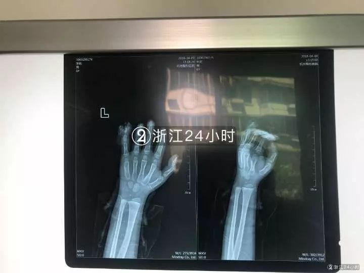 嚇哭！6歲男孩被夾斷手指 罪魁禍?zhǔn)拙故切７? oldsrc=