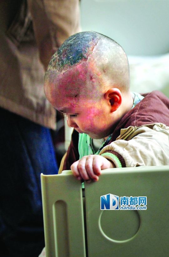 1月8日下午，小寶頭上和臉上都是傷痕。
