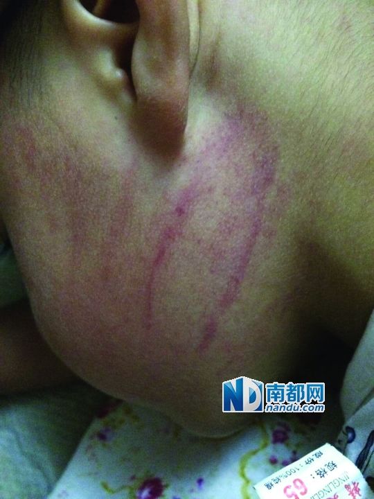 小逸臉上淤痕清晰可見。
