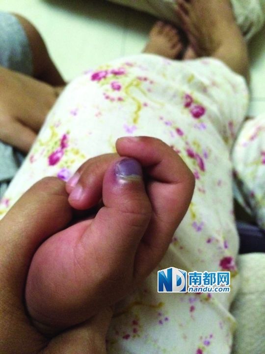 小逸手指被夾傷。