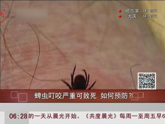 蜱蟲叮咬嚴(yán)重可致死如何預(yù)防？