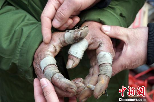 圖為由于常年拾荒，老人雙手布滿傷口。周小云 攝